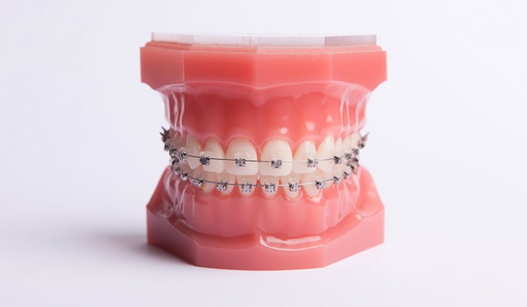 La durée du traitement d'alignement dentaire